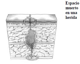 Suturas