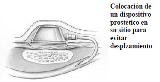 Suturas Suturas
