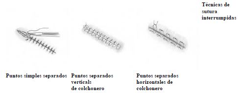 Suturas